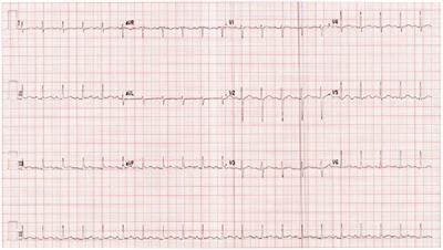 Case report: Severe sinus tachycardia as a leading manifestation of systemic lupus erythematosus flare